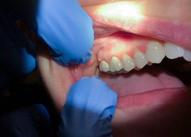 Best Emergency Dental Care for Broken or Chipped Teeth in Hillsboro, MO