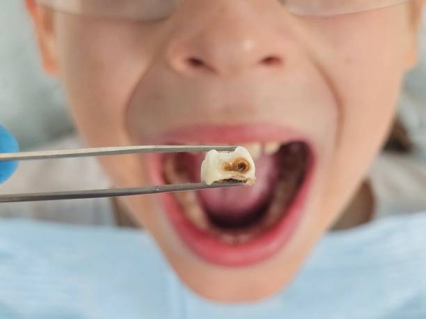 Best Emergency Treatment for Dental Infections or Abscesses in Hillsboro, MO