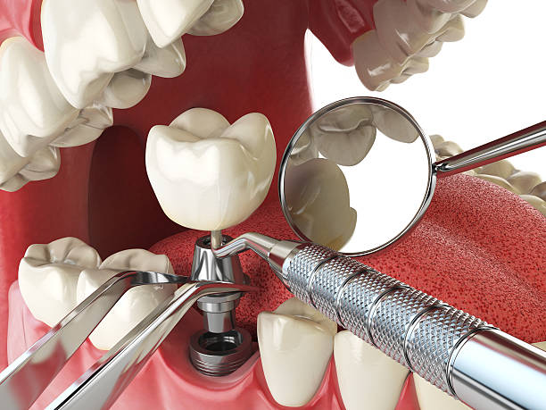 Best Emergency Tooth Extraction in Hillsboro, MO